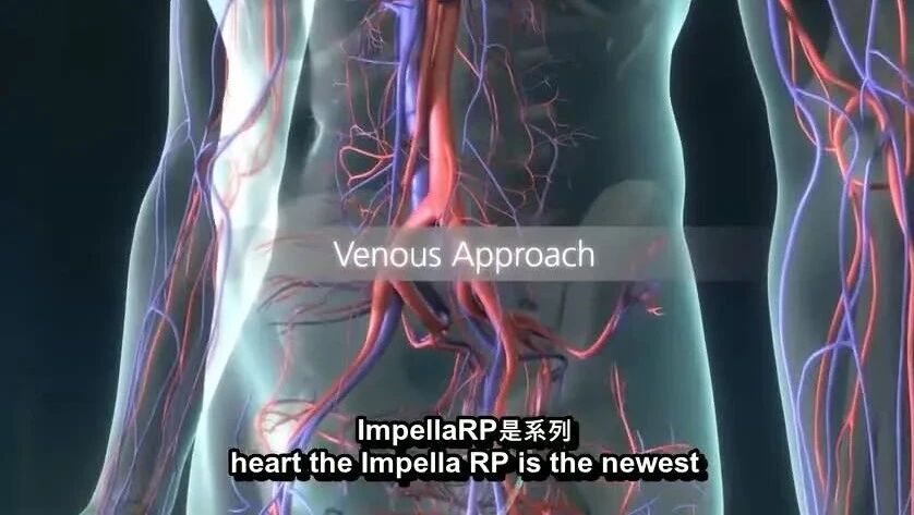 医学科普：Impella（心室辅助）