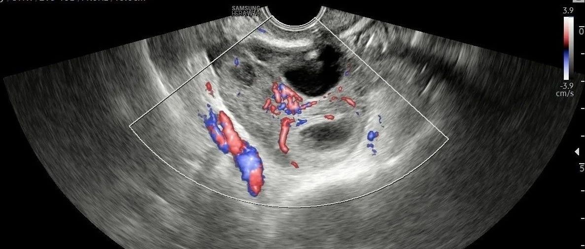 【病例分享】卵巢扭转一例
